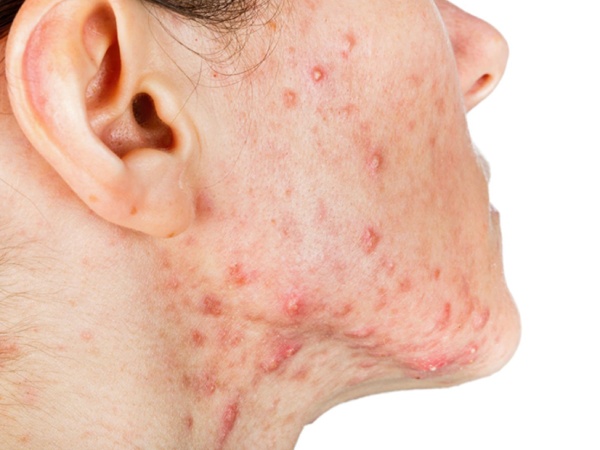 Nhìn thấy mụn có thông điệp gì, lựa chọn số mấy?